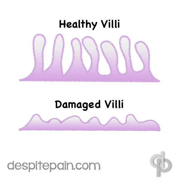 Illustration of healthy and damaged villi  - coeliac disease